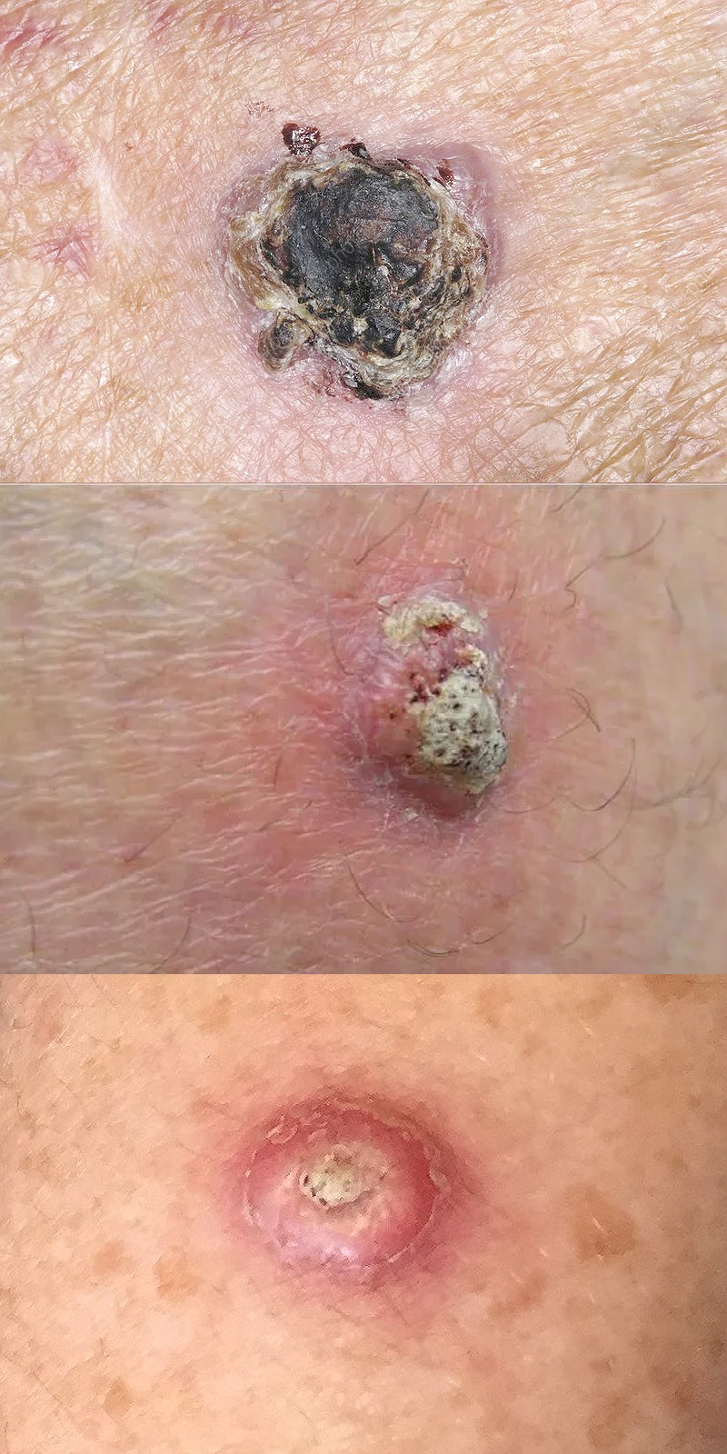 Squamous Cell Carcinoma Vlr Eng Br