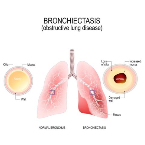 Surgical Treatment of Bronchiectasis - Saint John’s Cancer Institute Blog