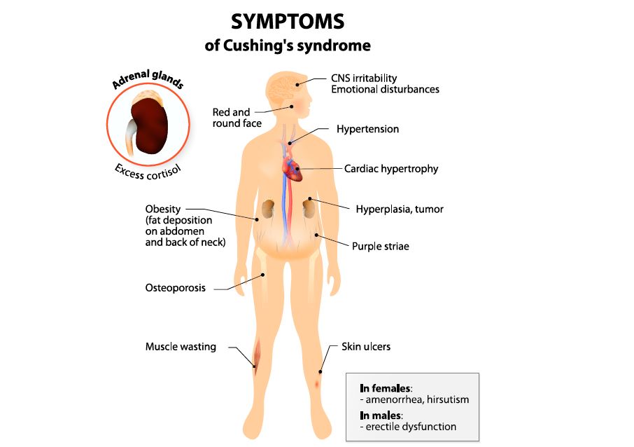 How To Identify High Cortisol Levels Cushing S Syndrome Saint John S Cancer Institute Blog