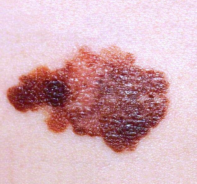 Detecting skin cancer early - Saint John's Cancer Institute