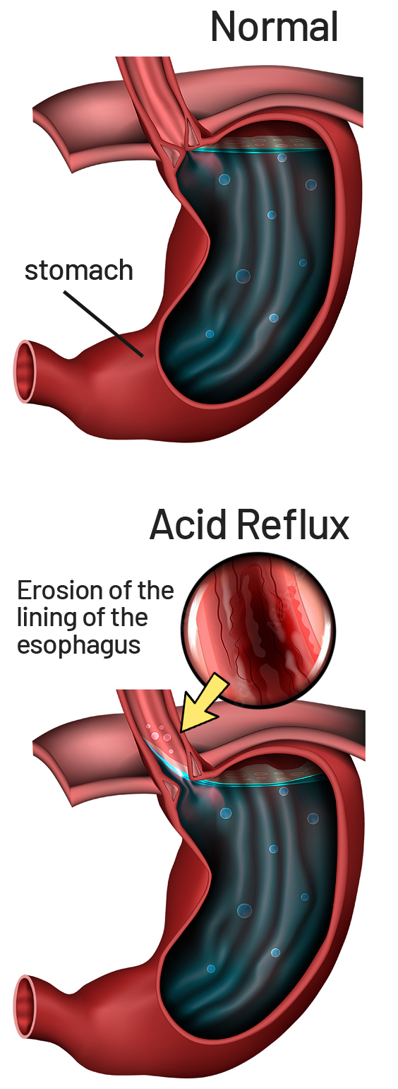 young-americans-and-esophageal-cancer-saint-john-s-cancer-institute-blog