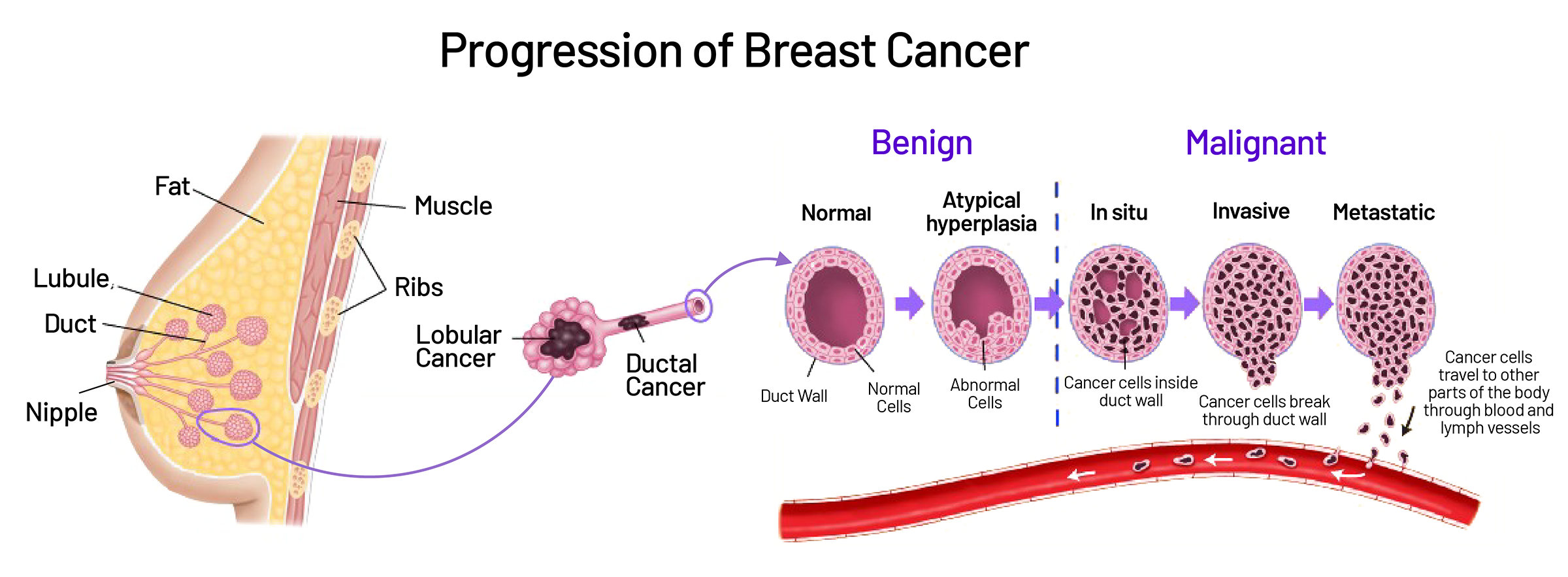 Breast Cancer and its types 