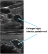 Parathyroid Imaging and Ultrasounds | Saint John’s Cancer Institute