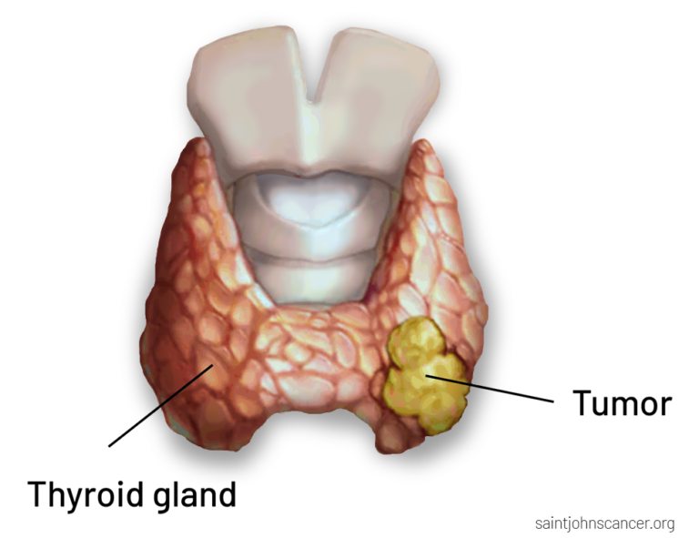 thyroid-cancer-symptoms-diagnosis-surgery-treatment-and-prognosis