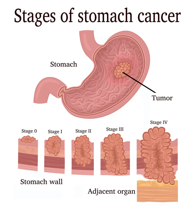 stomach cancer research article