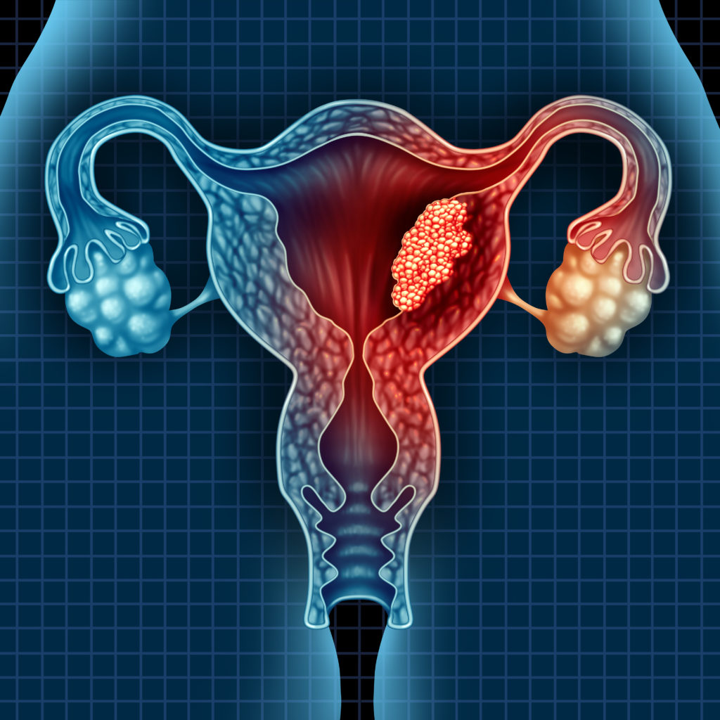 Uterine And Endometrial Cancer Saint John s Cancer Institute Santa 