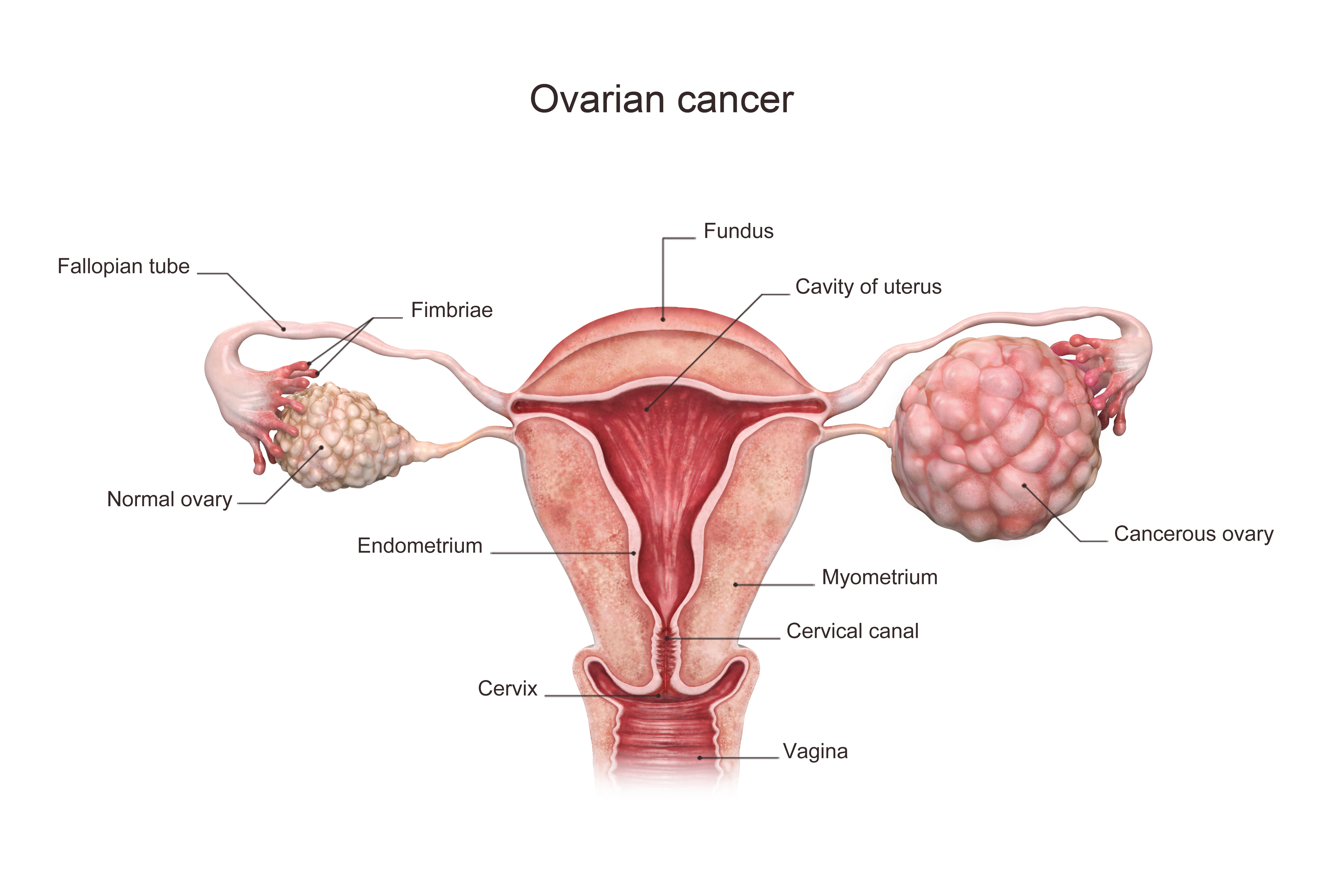 Ovarian Cancer Signs Symptoms And Diagnosis Saint John s Cancer 