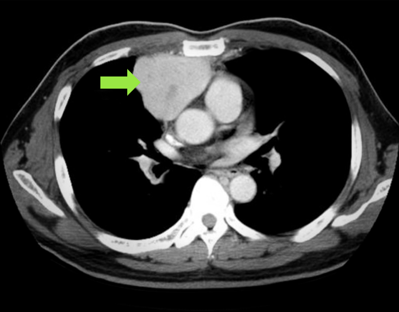 Mediastinal Mass (Tumor): Types, Symptoms, Causes & Treatment