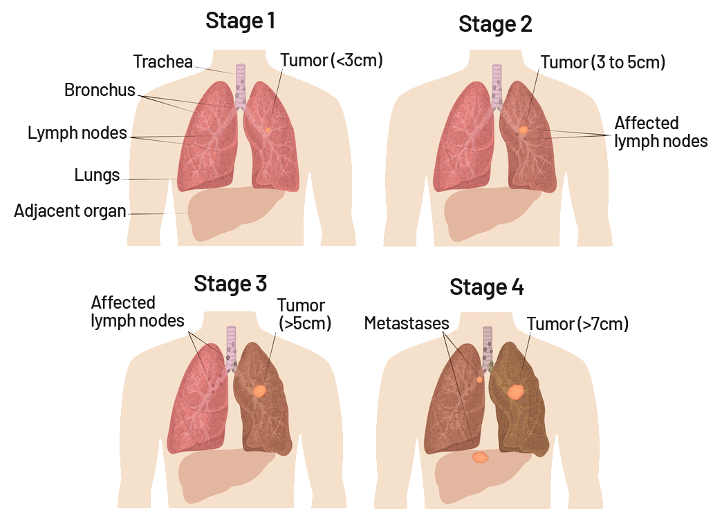 Lung Cancer Symptoms Risk Factors Diagnosis And Treatment Saint