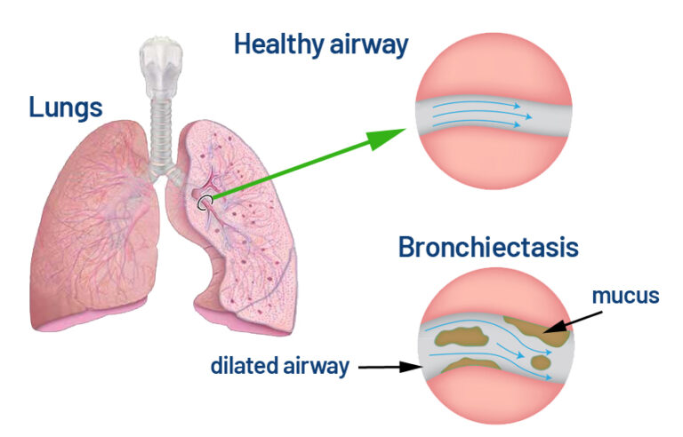 bronchiectasis-saint-john-s-cancer-institute