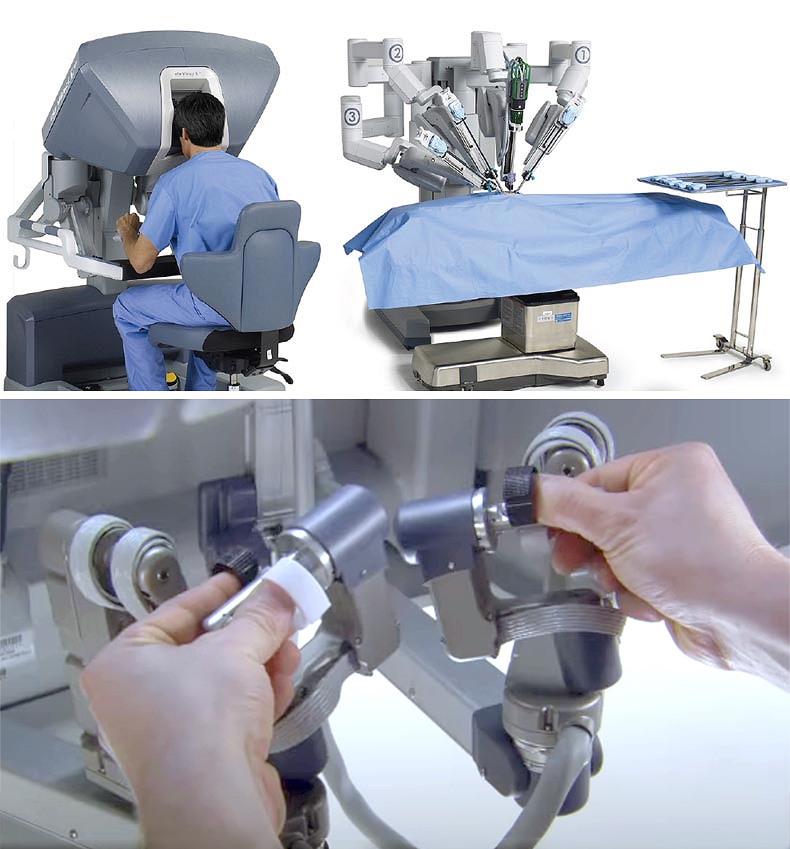 Robotic Prostate Cancer Surgery Saint John s Cancer Institute