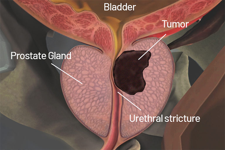 Prostate Cancer Signs Symptoms Risk Factors And Diagnosis Saint