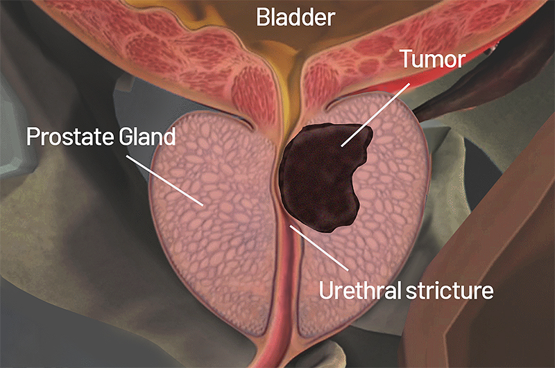 [Image: Prostate-gland-cancerous-tumor.jpg]