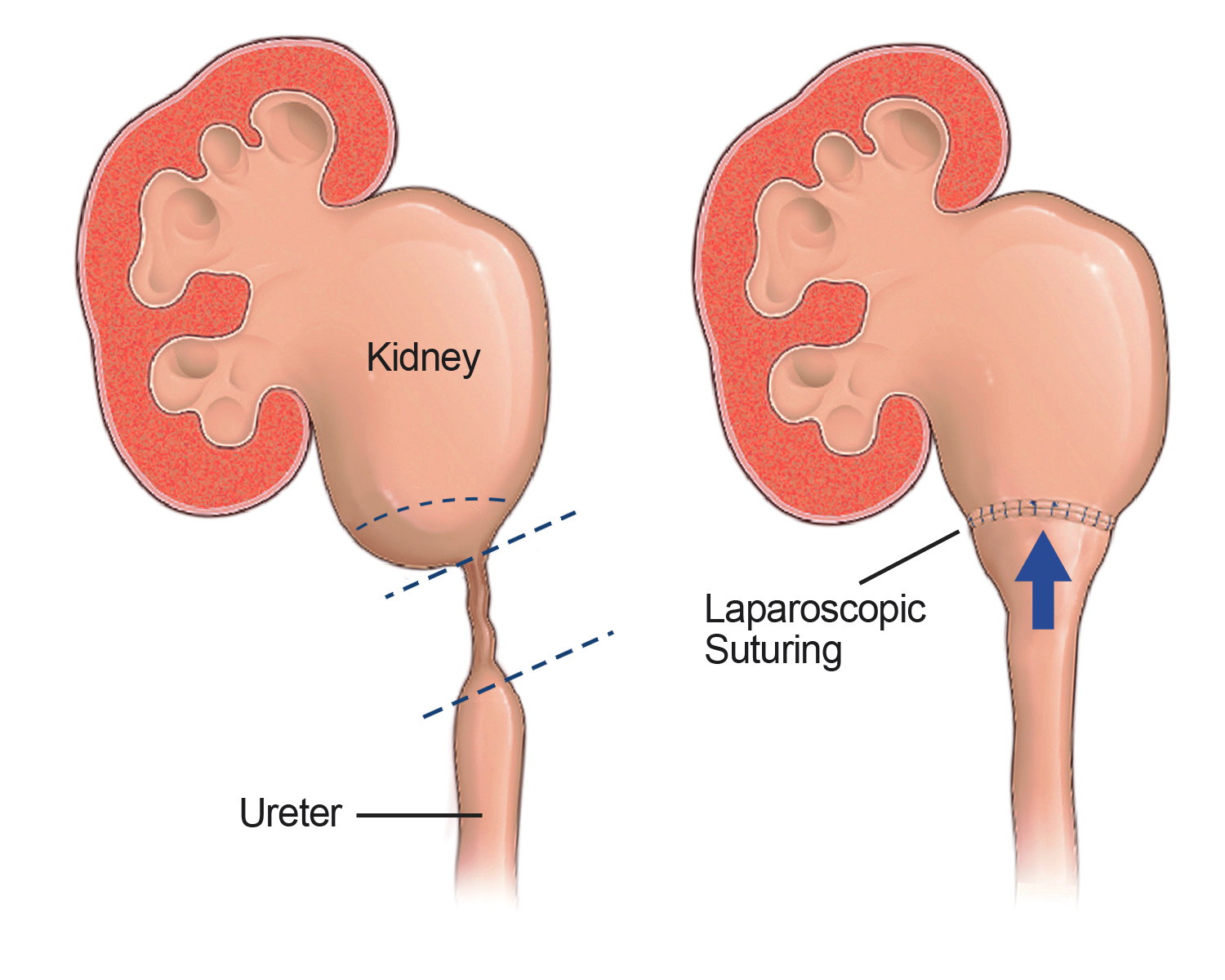 Urinary Obstruction And Ureteral Stricture Causes And Treatment