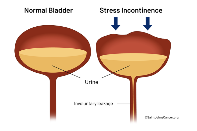 Voiding Dysfunction Causes, Symptoms, And Prognosis | Saint John’s ...