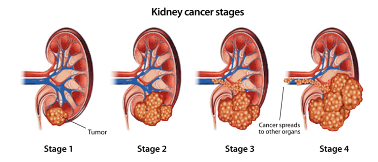 Kidney Cancer (Renal Cancer) Signs, Symptoms | Saint John’s Cancer ...