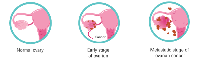 Webinar: Ovarian Cancer 101 - Saint John’s Cancer Institute